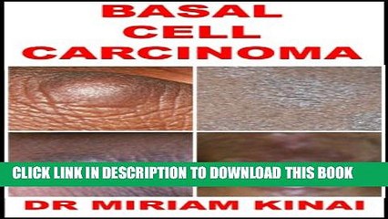 [PDF] Dermatology: Basal Cell Carcinoma (Skin Diseases Book 39) Full Online