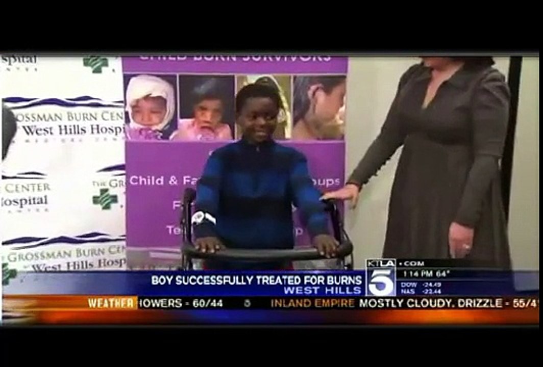 Boy Has Amazing Recovery After Burns Left Him Unable To Walk-SD