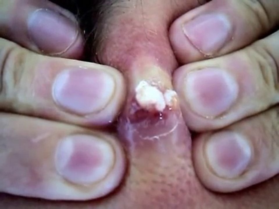 Huge zit