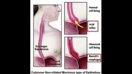 USMLE Highly Tested Topic: Barrett's Esophagus