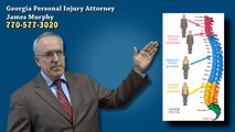 72.Spinal Cord & Paralysis Injuries from Auto Accident - Georgia Accident Attorney