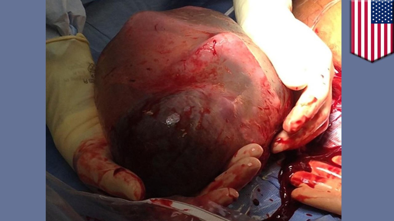 มหัศจรรย์ โอกาสเกิดแค่ 1 ใน 80,000 ทารกคลอดก่อนกำหนด 3 เดือนในถุงน้ำคร่ำ