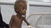 انتشار سوء التغذية بقرى المتينة غربي اليمن