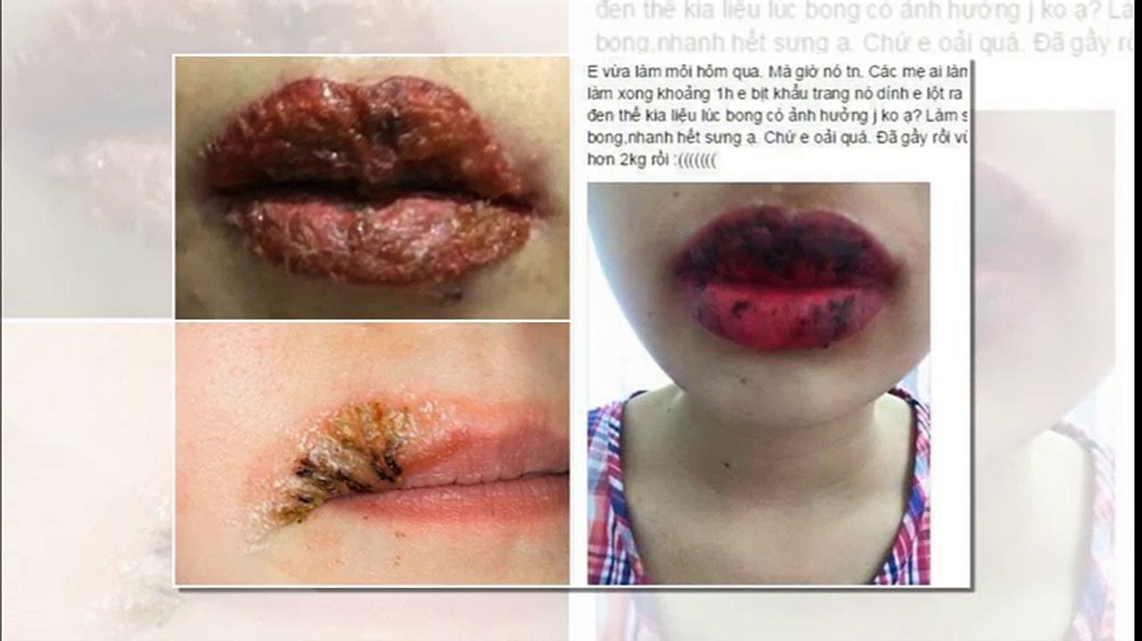 Những rủi ro có thể đến từ 3 thủ thuật thẩm mỹ phổ biến