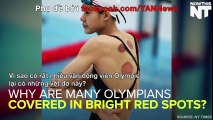 Vì sao có rất nhiều vận động viên Olympic lại có những vết đỏ này?