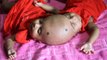 Surgery Hope For Conjoined Twins: BORN DIFFERENT