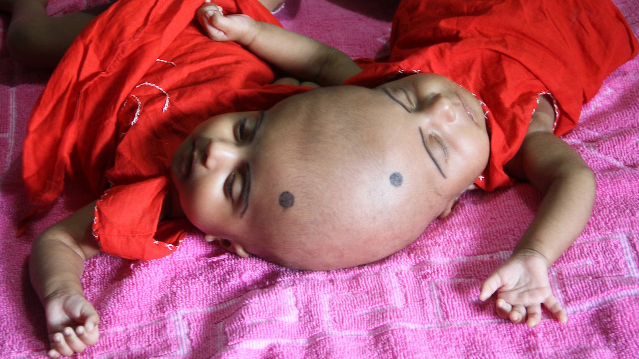 Surgery Hope For Conjoined Twins: BORN DIFFERENT