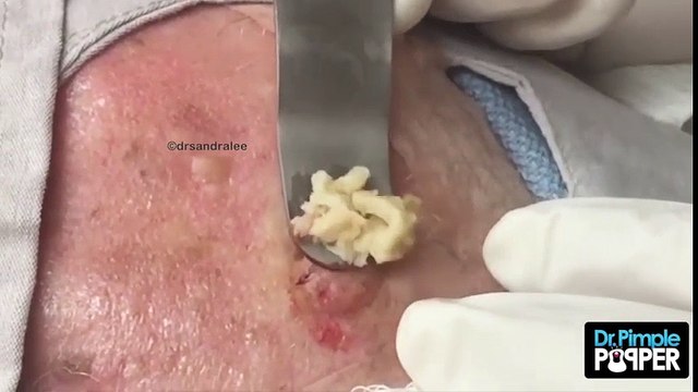 hết hồn với cảnh nặn mẹ của loại mụn mủ