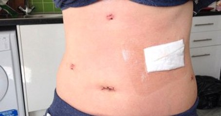 Yediği Her Şeyi Kusan Kadına Akalazya Teşhisi Konuldu