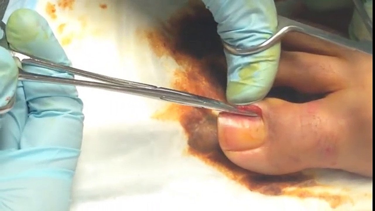 Cảnh lấy khoé móng thu hút 13 triệu lượt xem