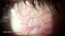 Ghê rợn cảnh lấy ra con giun kí sinh 2 năm trong mắt bệnh nhân