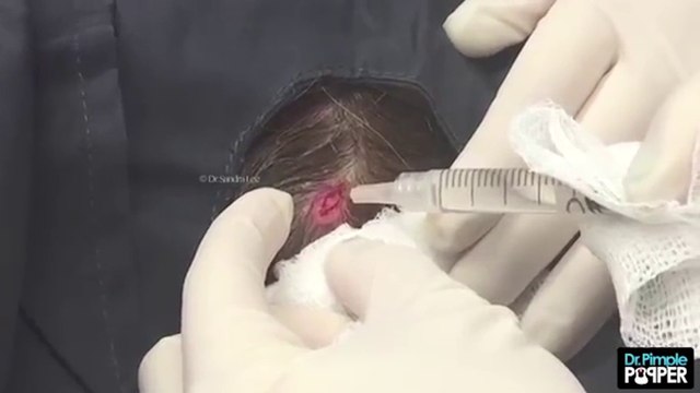 Cận cảnh siêu mụn được nặn