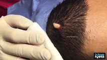Cận cảnh phẫu thuật lấy khối u nang trên đầu thanh niên