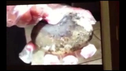 Túi nâng ngực chứa đầy nấm mốc