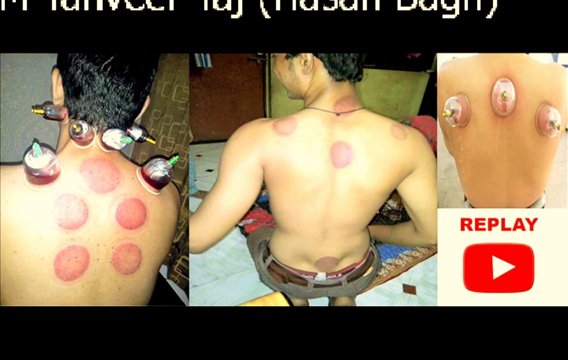 Hijama (Hasan Bagh Nagpur) 2016 part 2