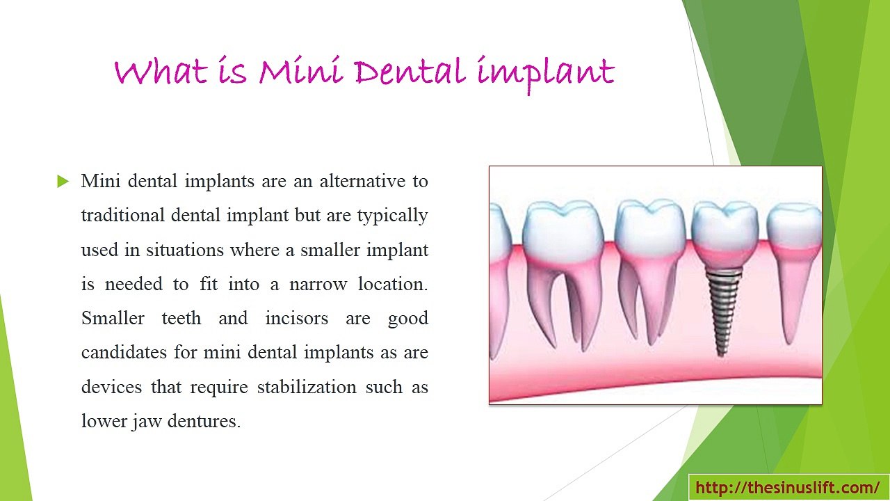 mini dental implants