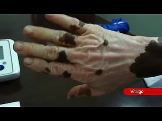 Vitiligo Treatment in Kerala  -  How to Treat Vitiligo