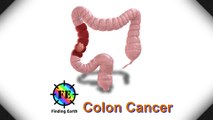 Colon Cancer - Symptom, Causes & Diagnosis (Finding Earth)