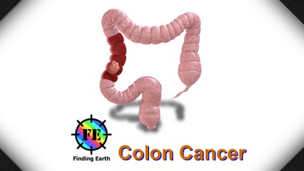 Colon Cancer - Symptom, Causes & Diagnosis (Finding Earth)