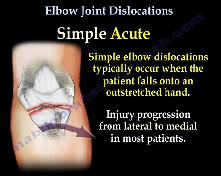 Elbow Dislocations - Everything You Need To Know - Dr. Nabil Ebraheim