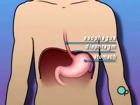 Medical Videos Hiatal Hernia 3D Medical Animation