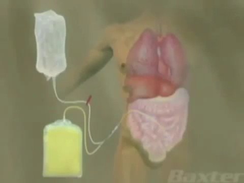 Peritoneal Dialysis for Kidney Disease