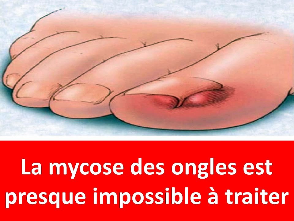 La mycose des ongles est presque impossible à traiter, Son astuce vous en débarrassera en 14 jours