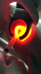 Injection de mousse sous contrôle du veinlite.