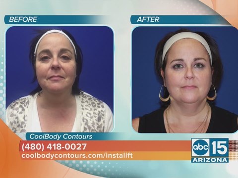 CoolBody Contours offers a facelift without surgery