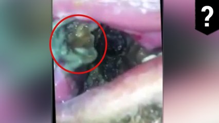 Dentist finds nasty wriggling mass in man’s mouth