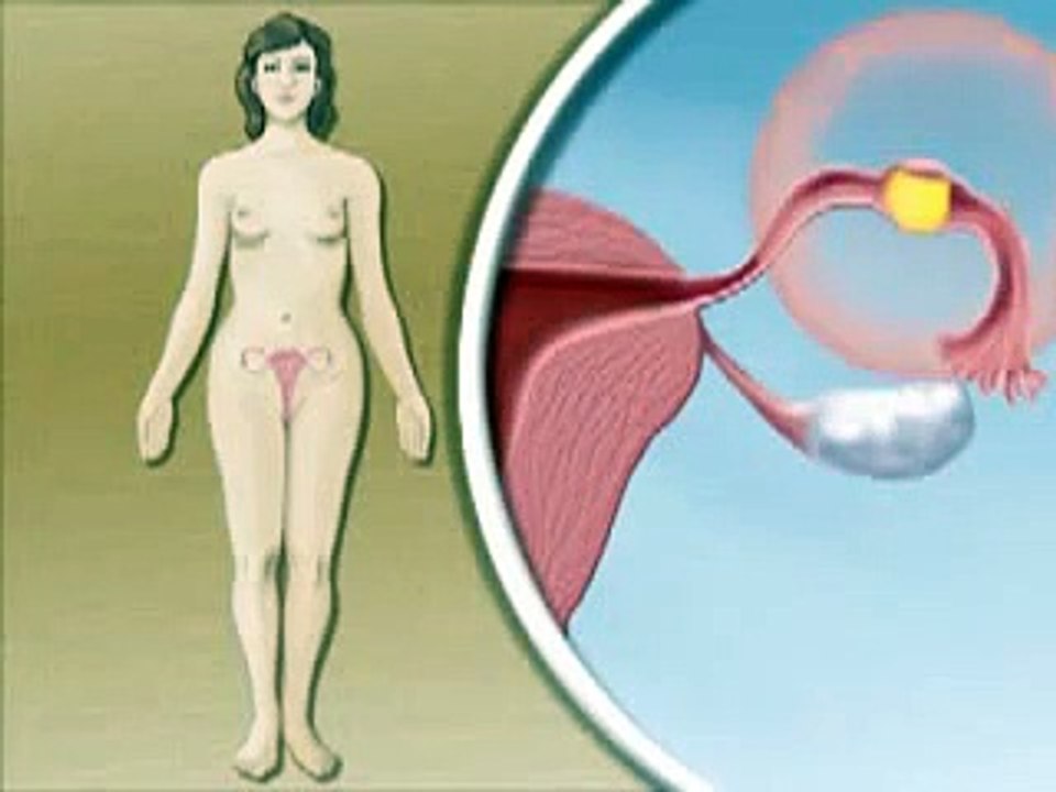 Medical Videos  Ectopic Pregnancy