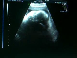 3EME ECHOGRAPHIE (3)