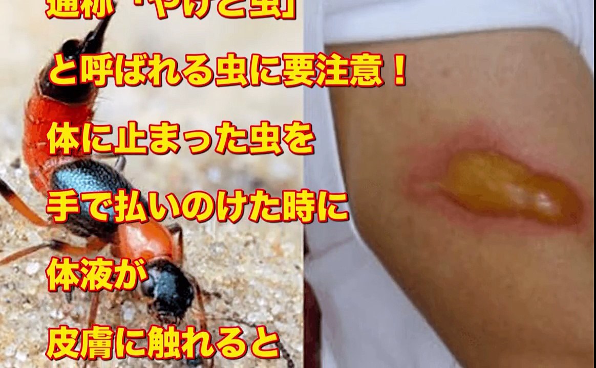 【※拡散希望※】体に付いても絶対叩くな！夏に大量発生する『やけど虫』がヤバすぎる・・・