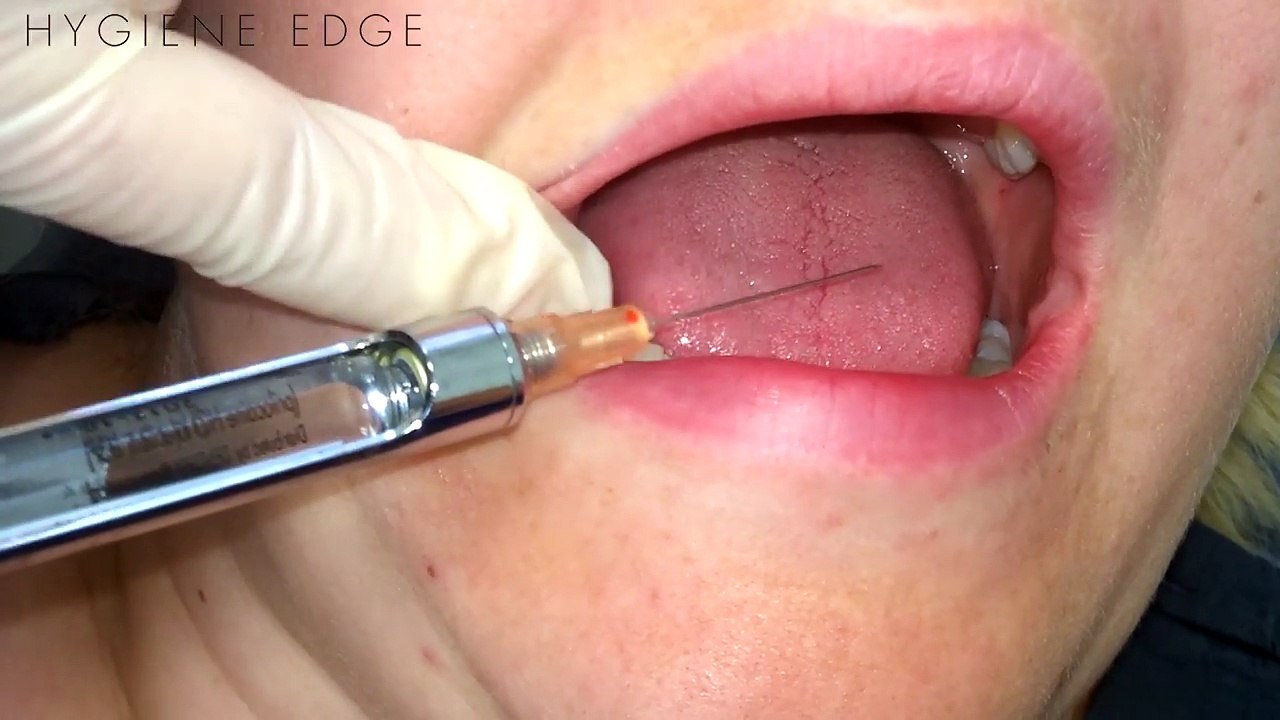 Common Errors on the IA injection