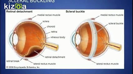 What is Retinal Detachment
