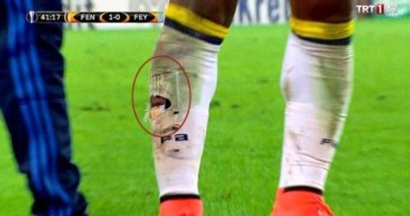 Lens'in Bacağında, Maçta Aldığı Darbeler Nedeniyle Kanama Oluştu