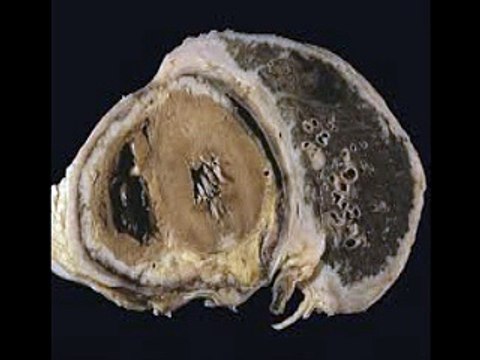 Mesothelioma Lawyer Center | Leading Asbestos Attorneys