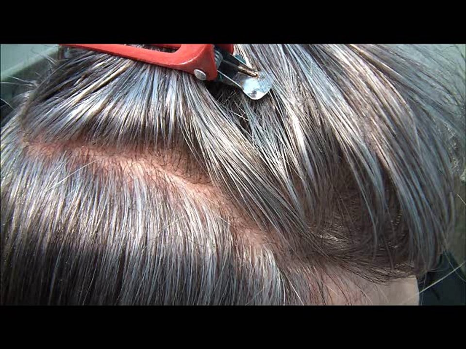 protesi capelli uomo