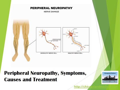 Peripheral Neuropathy, Symptoms, Causes and Treatment