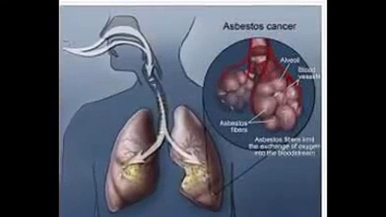 ASBESTOS LUNG CANCER