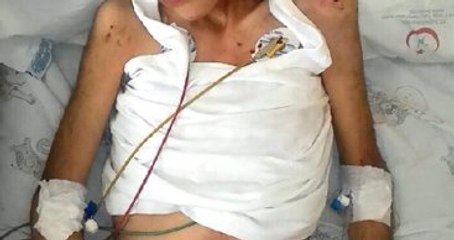 Annesinin İşkence Ettiği ve Ölümle Burun Buruna Gelen Çocuk Hayati Tehlikeyi Atlattı