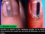 Vos ongles sont très révélateurs de votre état de santé -15 signes à ne pas prendre à la légère