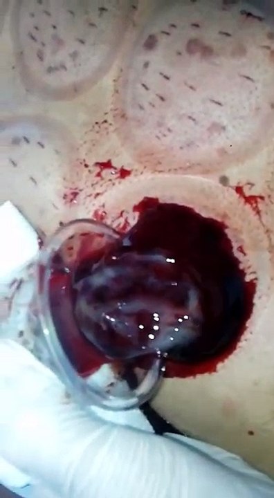 HACAMATLA GELEN ŞOK EDİCİ KAN-2 VAN ŞİFA HACAMAT 0532 172 15 66