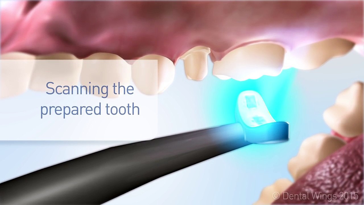 Usinagem de proteses dentarias a laser