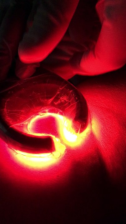 La mousse endoveineuse fibrosante: c'est un com...