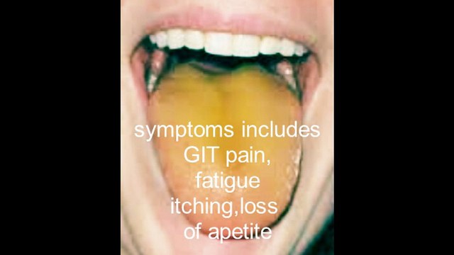 Obstructive jaundice-Detail -causes,symptoms and treatment