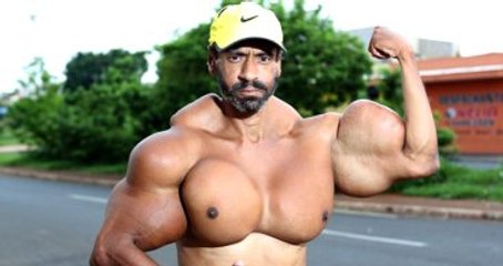 Hulk'a Benzemek İçin Kaslarına Yağ Enjekte Ediyor