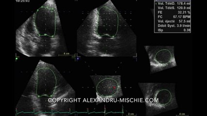 3D LVEF Examples: Left Ventricle Frames