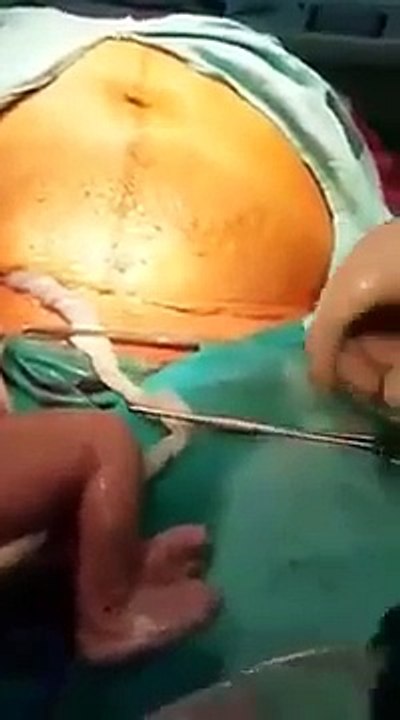 Video Operasi_Bedah_Sesar_Anak_Kembar
