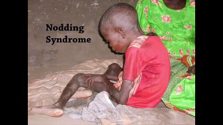 Nodding Syndrome